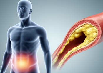 Waist-to-weight index linked to carotid artery thickening in rural China study