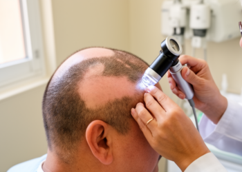 Alopecia Areata in Mexico: Steroid Reliance and Low Treatment Satisfaction Persist Across Disease Severity