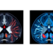 Radiomics Meets MR Cytometry: AI Sharply Improves Breast Tumor Diagnosis on MRI