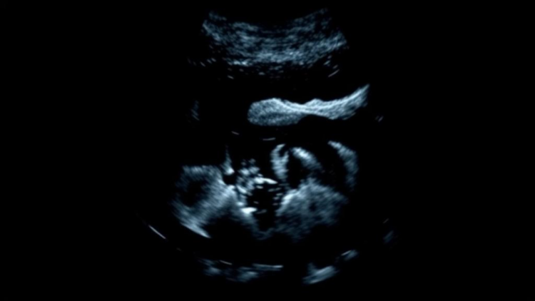 Two new US patents widen Ultrasound AI’s reach from pregnancy imaging to drug detection
