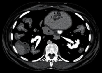 Spectral CT Muscle and Tissue Measures Predict Survival After Junctional Cancer Surgery