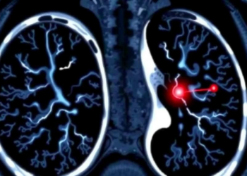 AI Reads Chest Scans to Predict Lung Cancer Type When Brain Metastases Strike First