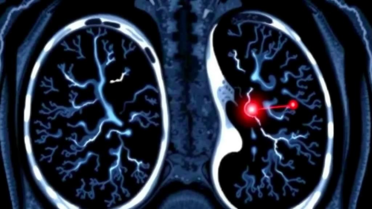 AI Reads Chest Scans to Predict Lung Cancer Type When Brain Metastases Strike First