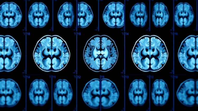 AI Reads Brain Scan Sequences to Spot Alzheimer’s With New Hybrid Model