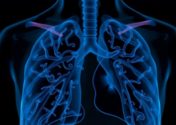 Seven Silent Years: When Bronchiectasis Foreshadows a Deadly Autoimmune Disease