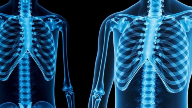 Parathyroid Hormone Runs Low in Diabetic Patients With Osteoporosis, Study Finds