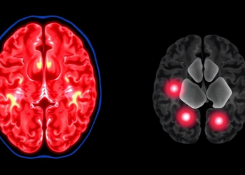 Blood Test Reveals Hidden Brain Injury After Mini-Strokes With Normal Scans