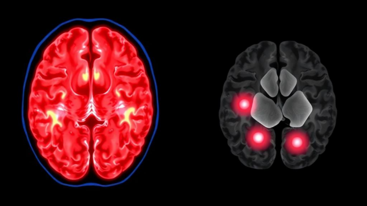 Blood Test Reveals Hidden Brain Injury After Mini-Strokes With Normal Scans
