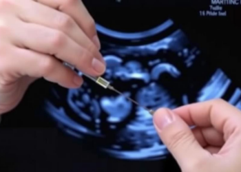 Ultrasound-Guided Lumbar Puncture Training Could Transform Bedside Neurology Care