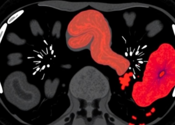 AI Learns to Spot Bile Duct Cancer on Multiphase CT Scans