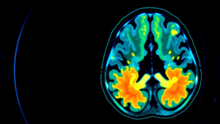PSMA PET/CT-guided biopsy finds hidden prostate cancers that MRI misses