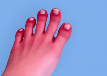 Rare Toe Tumor: Ewing Sarcoma Masquerades as Injury in a 12-Year-Old