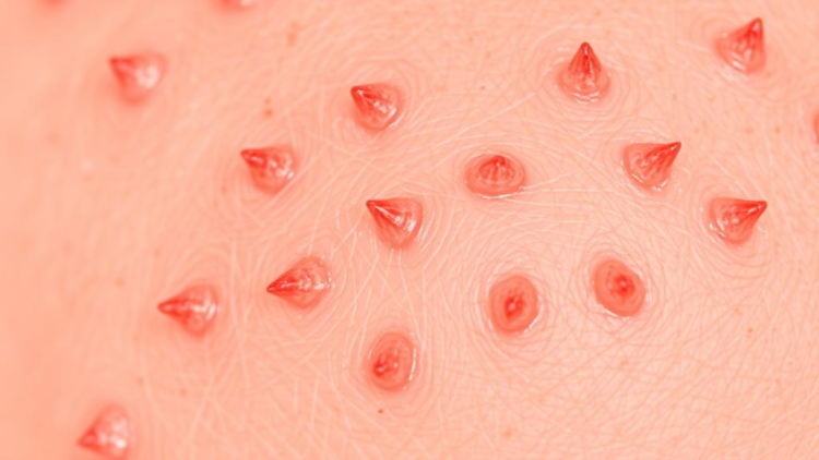 Itchy Skin Condition Prurigo Nodularis Linked to Skin Cancer Risk in Large Cohort Study