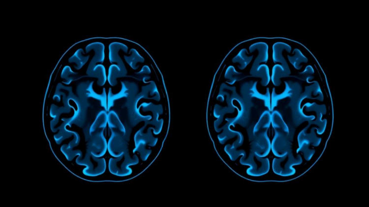 AI Reads Routine MRI Scans to Predict Brain Invasion in Meningiomas Before Surgery