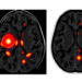 AI Reads Tumor Habitats on MRI to Predict Prostate Cancer Aggressiveness Before Surgery