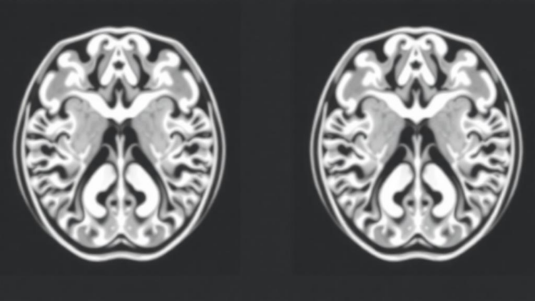 Tracer Debate: Fluorinated MIBG Alternative Sparks Scientific Exchange in Neuroblastoma Imaging