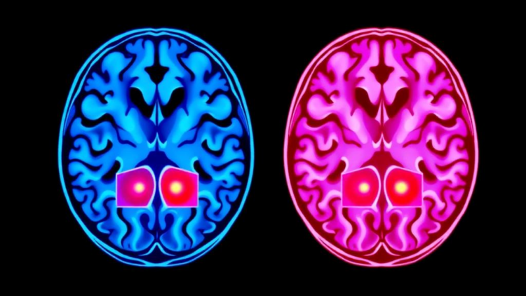AI Reads Brain Scans Two Ways at Once to Gauge Neurological Disease Severity