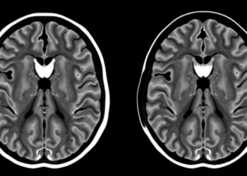 High-Resolution MRI Shows Stroke Risk Follows Different Rules in Moyamoya Disease and Its Atherosclerotic Mimic