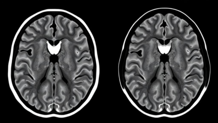 High-Resolution MRI Shows Stroke Risk Follows Different Rules in Moyamoya Disease and Its Atherosclerotic Mimic