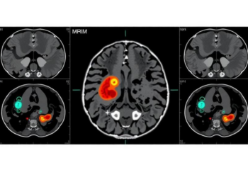 AI Reads MRI Scans to Predict Hidden Gastric Cancer Spread Before Surgery