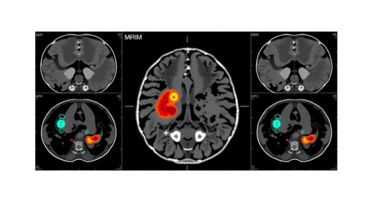 AI Reads MRI Scans to Predict Hidden Gastric Cancer Spread Before Surgery