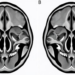CT Mapping of Four Zygomatic Sutures Reveals Distinct Geometry and Uneven Left-Right Symmetry