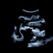 Ultrasound Offers an Objective Window Into Morphea Treatment Response