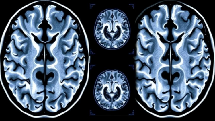 Brain Scans Reveal When Alzheimer’s Damage First Appears in Younger Patients