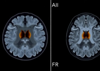 AI Reads Eye Scans: Machine Learning Spots Dangerous Orbital Tumors on MRI
