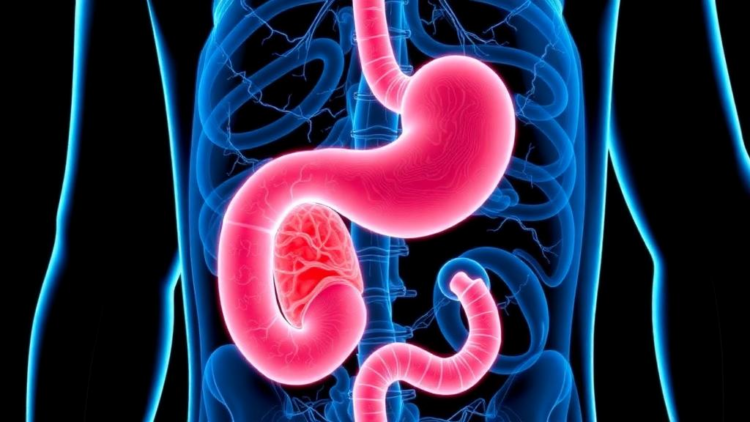 Pancreatic Cancer Is Being Caught Earlier Than Ever, Landmark 20-Year Analysis Finds