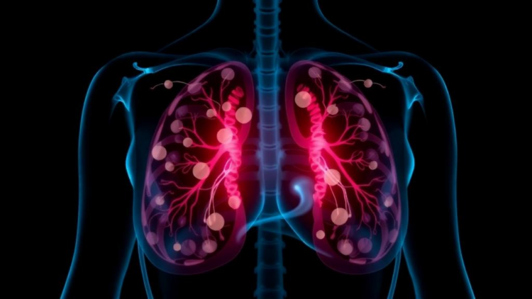 New Prediction Tool Could Spare Breast Cancer Patients Unnecessary Lymph Node Surgery