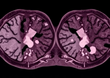 Indirect Trial Comparison Suggests Retifanlimab Edges Out Avelumab in Metastatic Merkel Cell Carcinoma