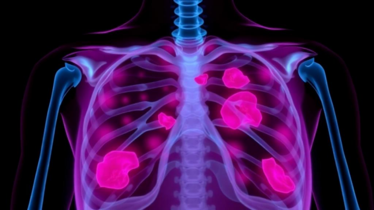 Race and Income Predict Survival in Breast Cancer That Spreads to Bone, Study Finds