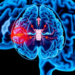 Brain Scans Reveal Hidden Damage When Diabetes Meets Small Vessel Disease