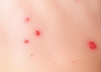Itchy Skin, Low Blood Counts: Study Probes Anemia Risk in Children With Eczema