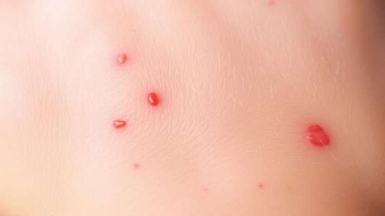 Itchy Skin, Low Blood Counts: Study Probes Anemia Risk in Children With Eczema