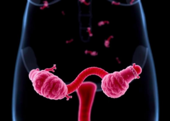 How Gut Bacteria May Drive Insulin Resistance in Polycystic Ovary Syndrome