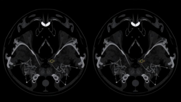 Calcium Clues: Ultrasound Patterns That Reveal Cancerous Salivary Gland Tumors