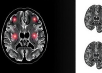 Random-Walk MRI Physics Predicts How Hard a Brain Tumor Is Before Surgery