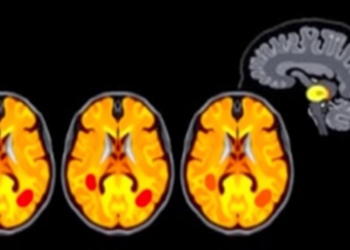 AI Framework Spots MS Lesions With Record Accuracy by Fusing MRI and Clinical Data
