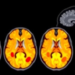 AI Framework Spots MS Lesions With Record Accuracy by Fusing MRI and Clinical Data