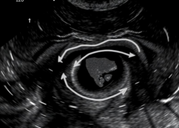 Ultrasound Takes Center Stage in Guiding Minimally Invasive Sclerotherapy for Ovarian Endometrioma