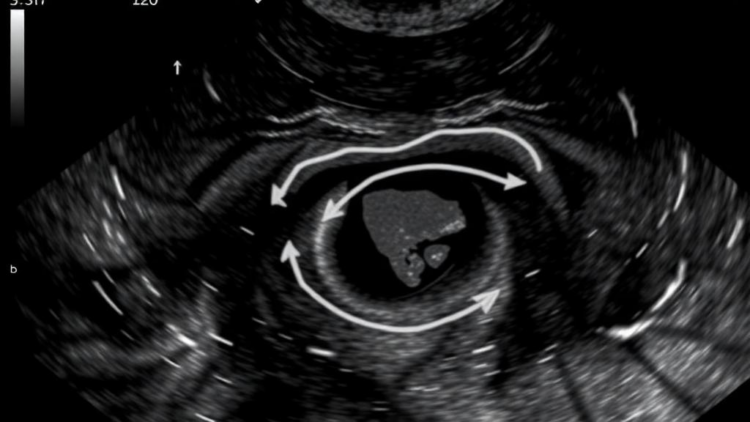 Ultrasound Takes Center Stage in Guiding Minimally Invasive Sclerotherapy for Ovarian Endometrioma
