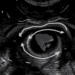 Ultrasound Takes Center Stage in Guiding Minimally Invasive Sclerotherapy for Ovarian Endometrioma