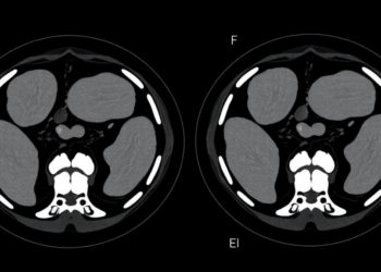 Fat-Invaded Muscle Seen on CT Scans Predicts Poor Recovery After Colorectal Cancer Surgery