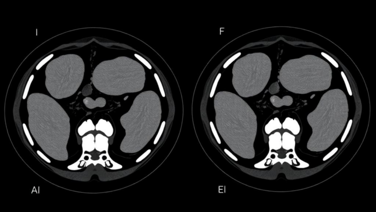 Fat-Invaded Muscle Seen on CT Scans Predicts Poor Recovery After Colorectal Cancer Surgery