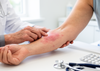 Skin Reactions From Bipolar Drug Oxcarbazepine Emerge Early, Case Series Finds