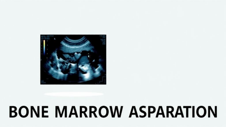 Ultrasound Takes the Guesswork Out of Bone Marrow Aspiration