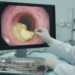 Coughing Up Blood Reveals an Exceedingly Rare Form of Airway Amyloidosis