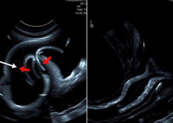 Ultrasound Strain Imaging Spots Hidden Heart Iron in Thalassemia Children Before MRI Can